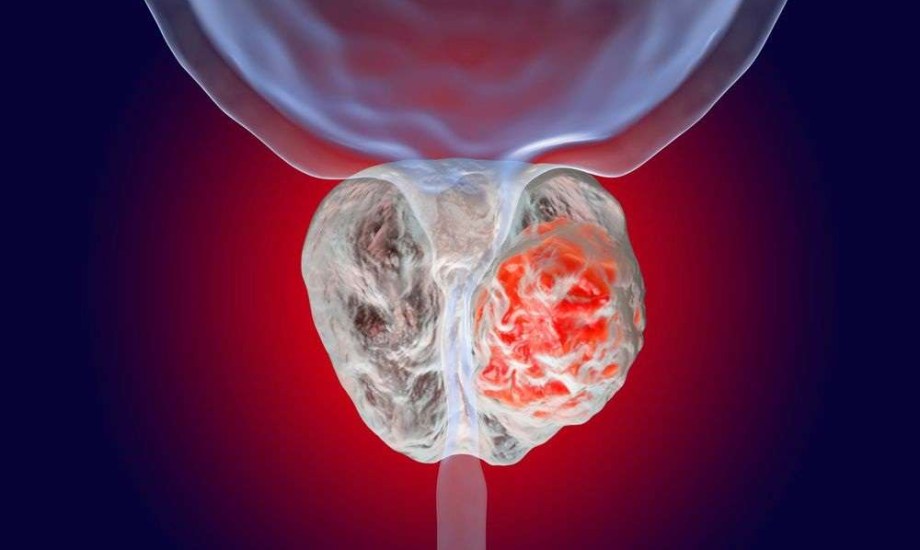 مزيج دوائي يقلل خطر تطور أورام البروستاتا المتقدمة 48%