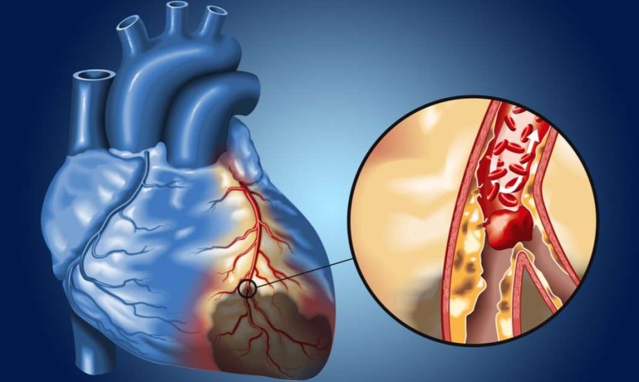 5 عادات يومية تقيك من انسداد الشرايين وأمراض القلب