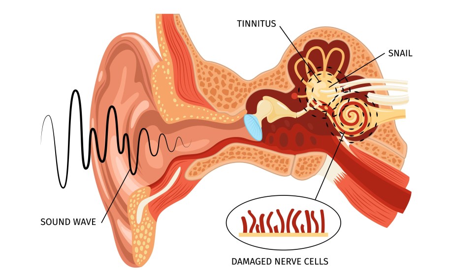 ذكاء اصطناعي يتنبأ بتحسن الكلام بعد زراعة القوقعة للأطفال
