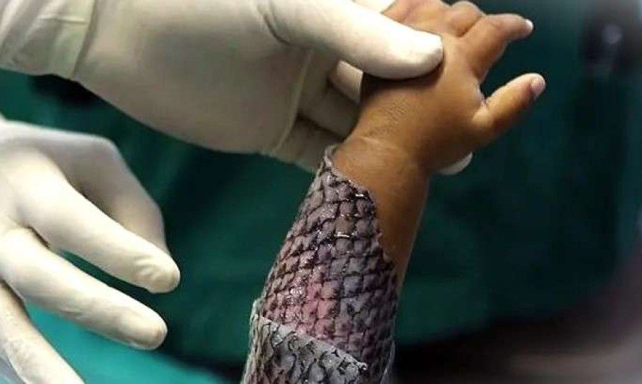 صورة من بي بي سي عن جلد السمك كبديل للترقيع التقليدي