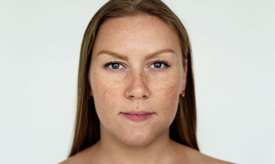 أسباب الكلف وطرق علاجه