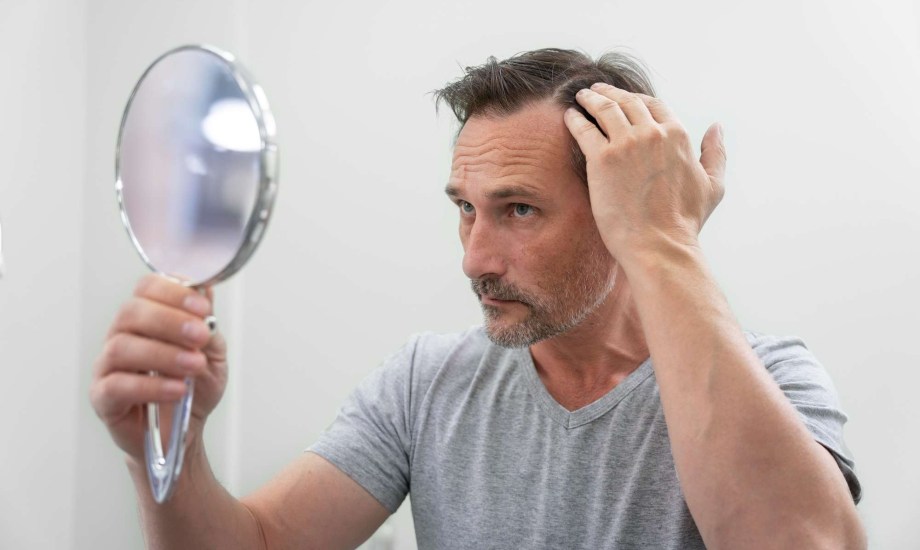تساقط الشعر عند الرجال