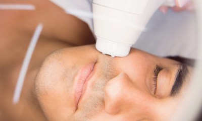 إزالة شعر الذقن بالليزر