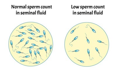 أعراض قلة الحيوانات المنوية