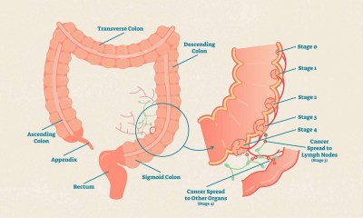 سرطان القولون والمستقيم