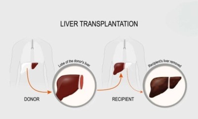 زراعة الكبد
