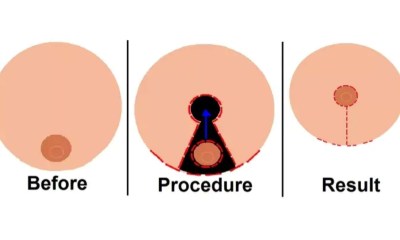 أسباب إجراء جاحة تصغير الثدي