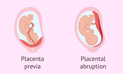 اعرفي الفرق بين المشيمة المنزاحة وانفصال المشيمة