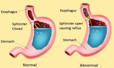 ارتجاع حمض المعدة