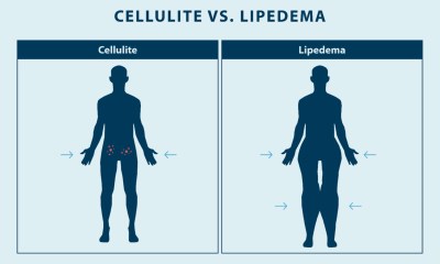 الفرق بين الوذمة الشحمية والسيلوليت