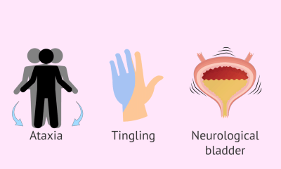 أعراض التصلب المتعدد