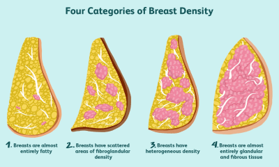 أنسجة الثدي الكثيفة شائعة الظهور عند النساء