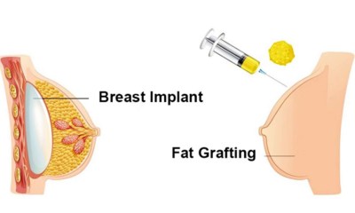 جراحة تكبير الثدي