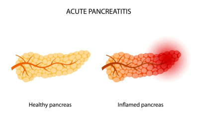 التهاب البنكرياس