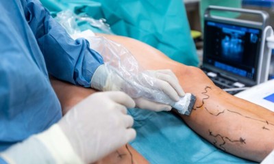 أفضل مراكز لعلاج دوالي الساقين في الوطن العربي
