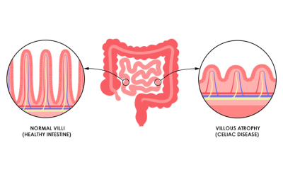 مرض السيلياك أو الداء البطني