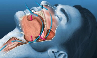 انقطاع النفس الانسدادي أثناء النوم
