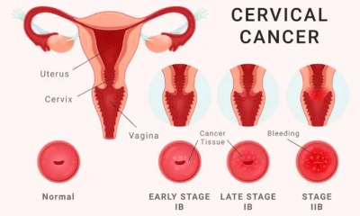 سرطان عنق الرحم