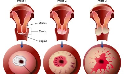 سرطان عنق الرحم