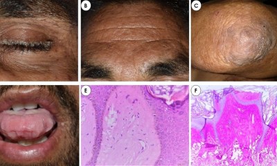 3 طرق لتشخيص الإصابة بمرض أورباخ فيته