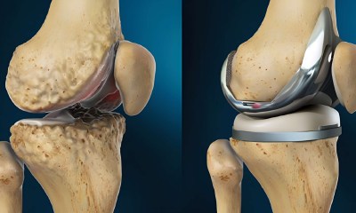 جراحة استبدال الركبة