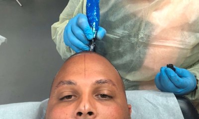 Microblading hairline