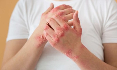 أعراض حساسية القمح