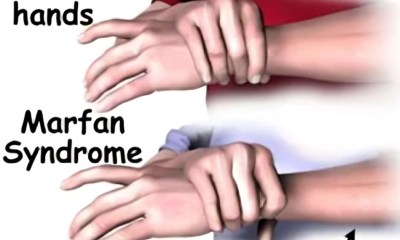 متلازمة مارفان