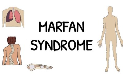 متلازمة مارفان