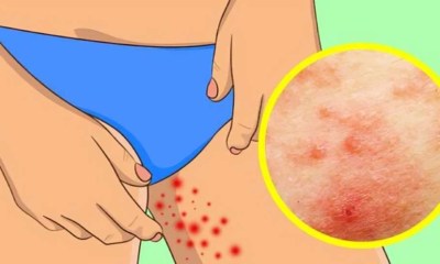 ظهور نتوءات حمراء بين الفخذين