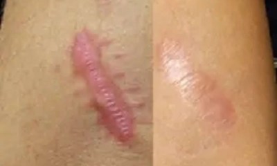 أسباب ندبة الجدرة