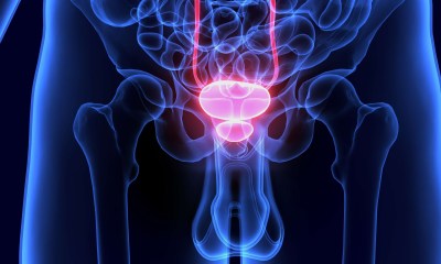 استخدام عقار Gozellix الجديد لتصوير سرطان البروستاتا