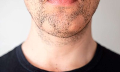 أعراض سعفة الذقن