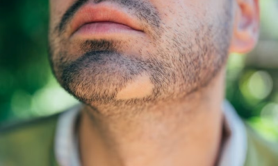 أعراض سعفة الذقن