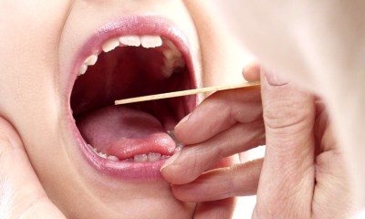 الإصابة بالتهاب الحلق العقدي