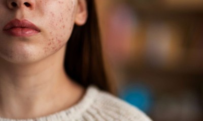 احذر  هذه البثور.. قد تكون مؤشرا خطيرا على أورام الجلد
