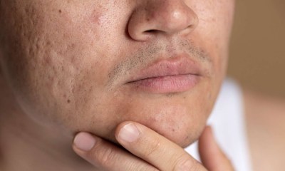 بعض بثور الوجه ناتجة عن انسداد مسام البشرة