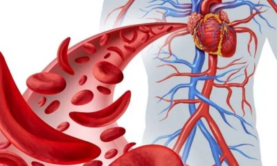 مرض الخلايا المنجلية لدى الأطفال
