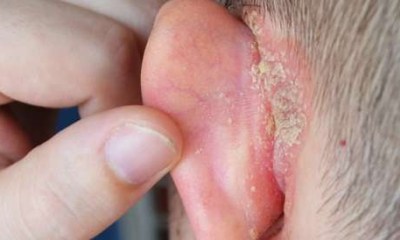 مخاطر إهمال تنظيف خلف الأذن
