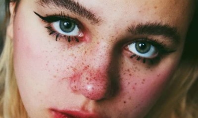 كيف تميز بين النمش والشامات الخطيرة؟