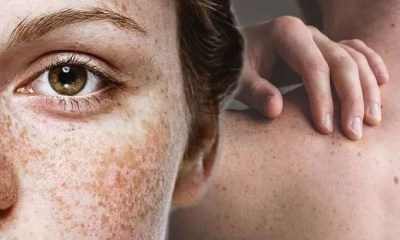 كيف تميز بين النمش والشامات الخطيرة؟