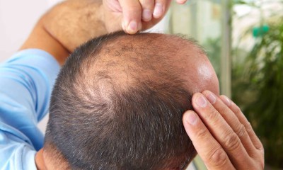 أعراض الصلع الوراثي