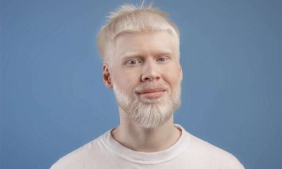 الأسباب العلمية الحقيقية للإصابة بالمهق