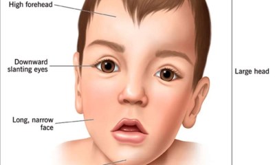 أعراض ضخامة الرأس