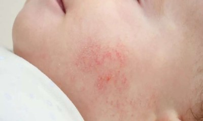 لماذا يُصاب الرضع بحروق الشمس بسهولة؟