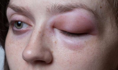 Andembry للوقاية من نوبات الوذمة الوعائية