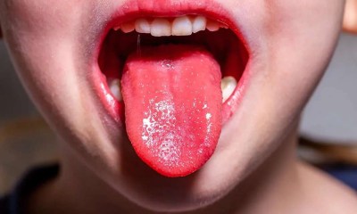 علاج لسان الفراولة عند الأطفال