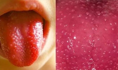 علاج لسان الفراولة عند الأطفال