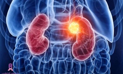 4 عادات يومية تزيد خطر الإصابة بأورام الكلى