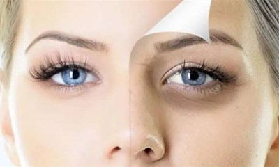 علاج الهالات السوداء تحت العين